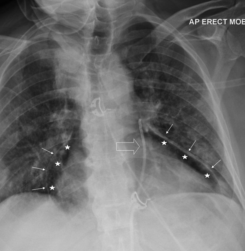 Chest X Ray For Pericardial Effusion At Joshua Freeman Blog Chest X Ray For Pericardial Effusion At Joshua Freeman Blog