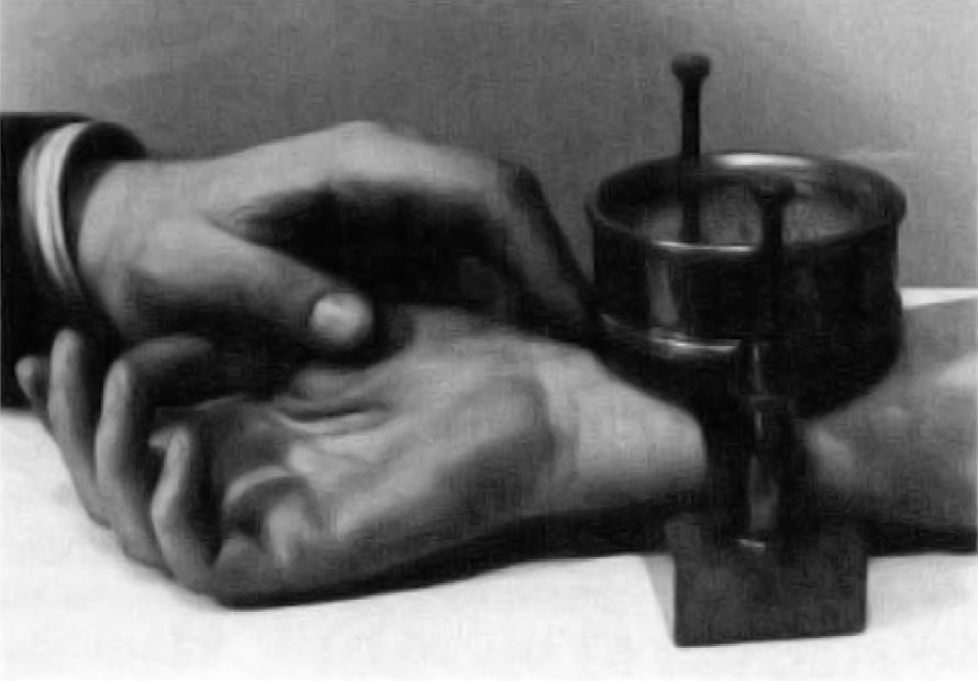 Fig. I Pulse Controller. made by Castagna of Vienna. 1885. A clock measures the pressure of a screw type clamp required to ob­literate the arterial pulse at the wrist. Image included by permission of John Wiley and Sons, Inc. Further usage of any Wiley content that appears on this website is strictly prohibited without permission from Wiley and Sons, Inc.