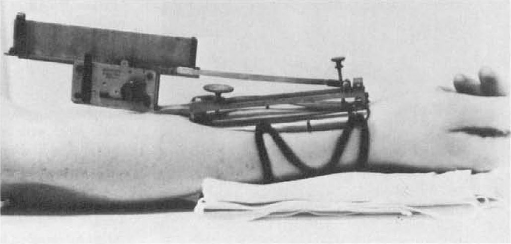 Fig. 5 Marey's Wrist Sphygmograph, 1857. This was the first clinical instrument by which the graphic method of registering the arterial pulse could be made in a living patient. Original instru­ment in the Reichert Collection, Cornell University Medical School. Image included by permission of John Wiley & Sons, Inc. Further usage of any Wiley content that appears on this website is strictly prohibited without permission from Wiley & Sons, Inc.