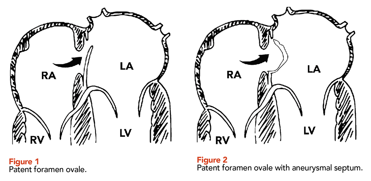 Ovale patent foramen