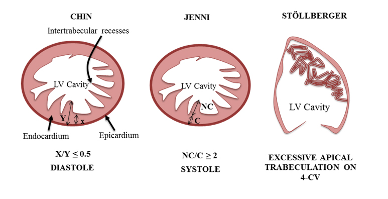 Left Ventricular Trabeculations in Athletes - American College of Cardiology