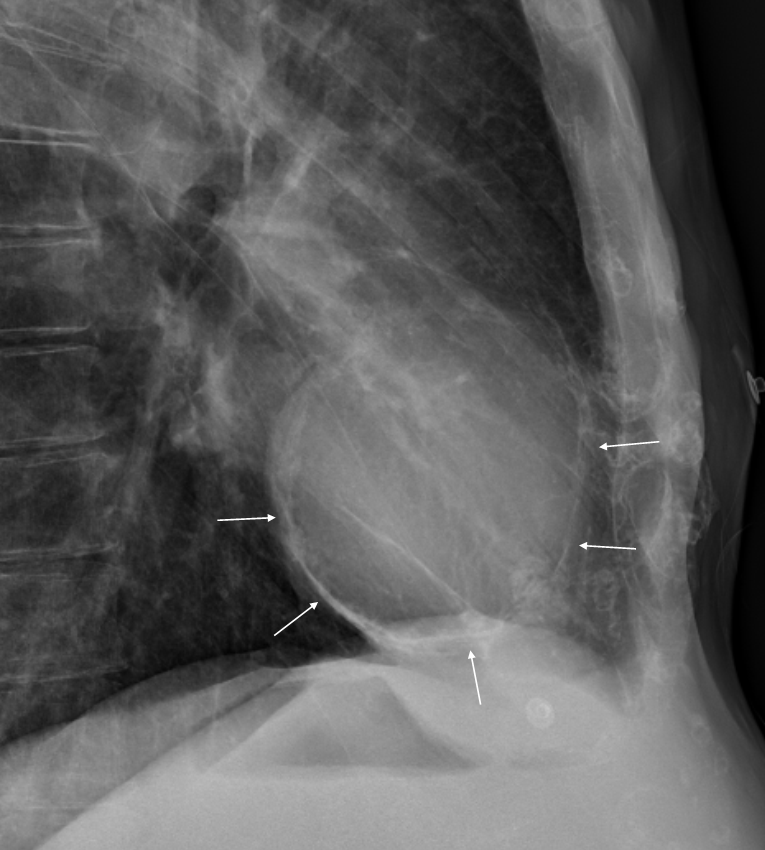 Chest Radiograph Signs Suggestive of Pericardial Disease American