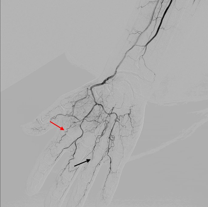 Thromboangiitis Obliterans (Buerger's Disease) American College of