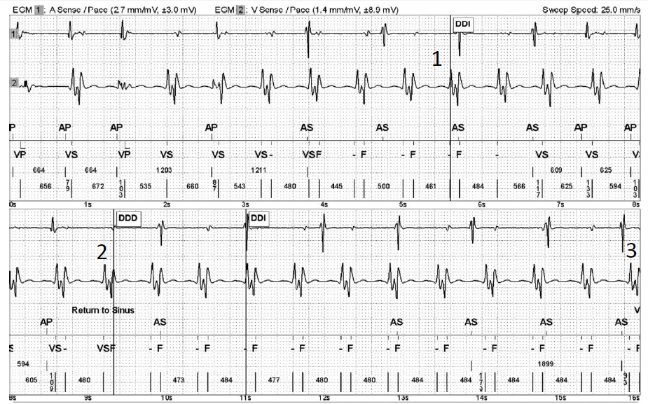 Ventricular Tachycardia With Double Counting of the R-Wave | Bordeaux ...