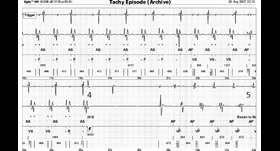 Searching for the Cause of HFpEF in Older Adults | Patient Case Quiz - Figure 1