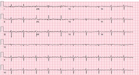 Searching for the Cause of HFpEF in Older Adults | Patient Case Quiz - Figure 1