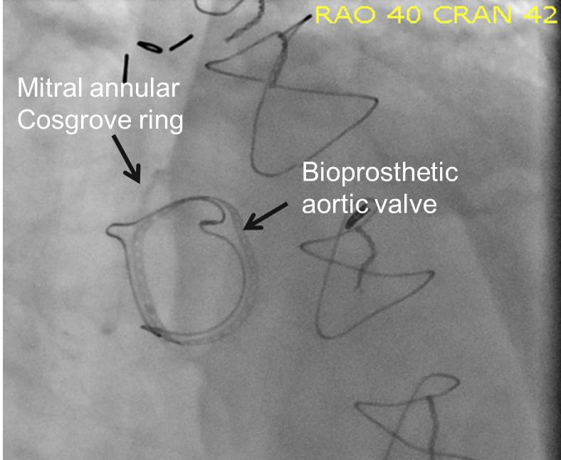 Interventional Mitral Annular Reduction Techniques - Cardiac Interventions  Today