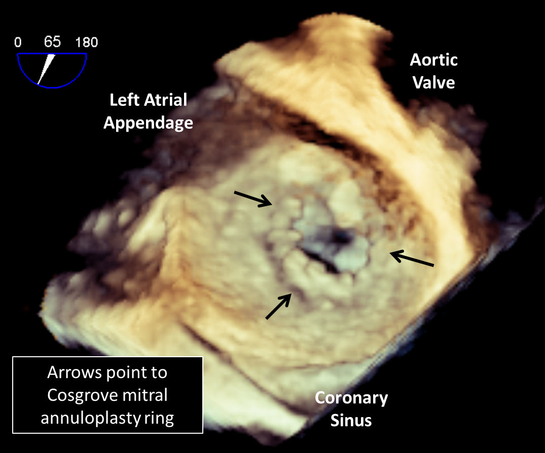 Review of Congenital Mitral Valve Stenosis: Analysis, Repair Techniques and  Outcomes | Cardiovascular Engineering and Technology