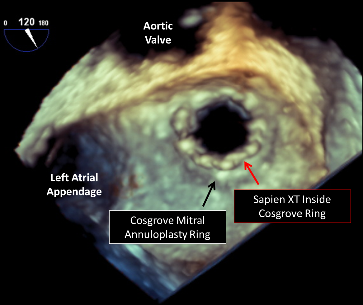 HVS - Development of a Mitral Annuloplasty Ring with Preserved Dynamics of  the Annular Height and Remodeling Capacity as Conventional Rigid and Semi  Rigid Rings