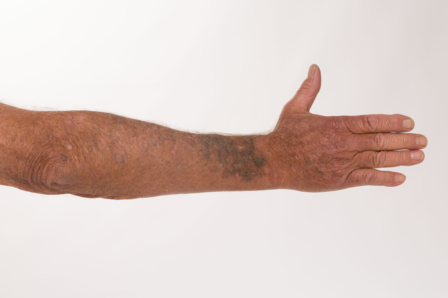 A 77 Year Old With Cutaneous Hyperpigmentation And Lower Extremity