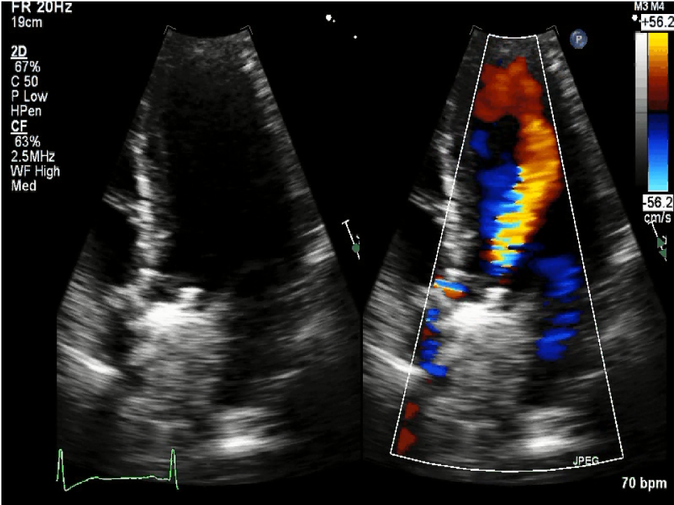 Pregnancy Complicated by Prosthetic Valve Thrombosis - American College