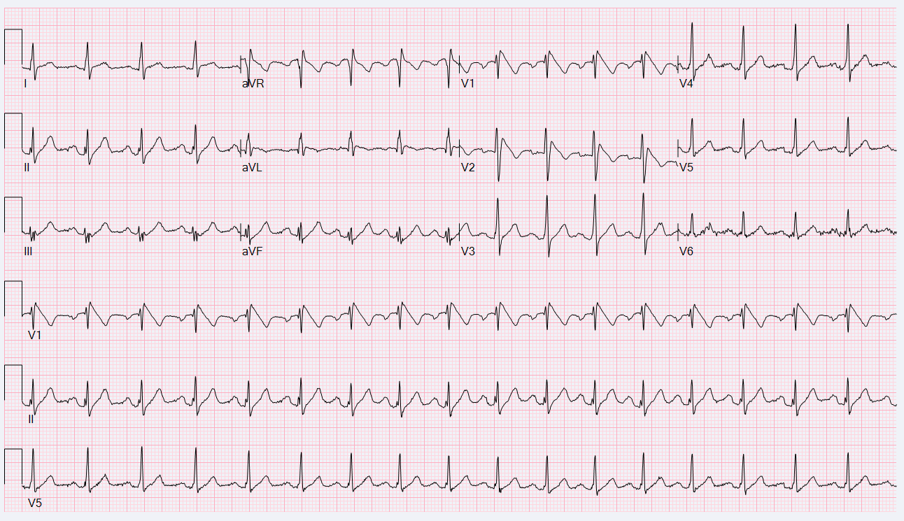 21 Year Old Male With Transient Abnormal Ecg American College Of Cardiology