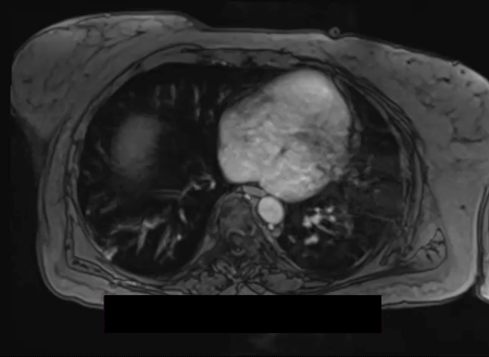 Figure 2B: Video of coronal stack through the chest