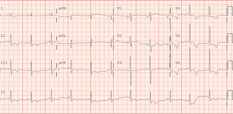Image 1: ECG From Clinic Showing Sinus Rhythm With Repolarization Abnormality