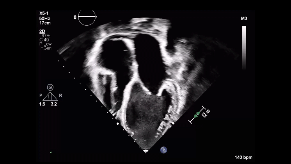 Video 1: 4Ch TTE of a Dilated LA and LV