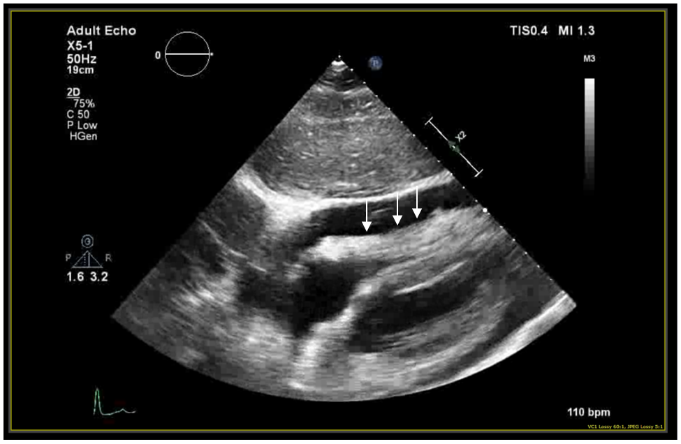 Fig 2: Echocardiogram