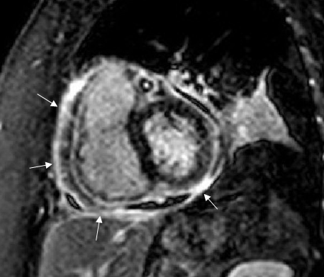 Fig 3:  Cardiac MRI