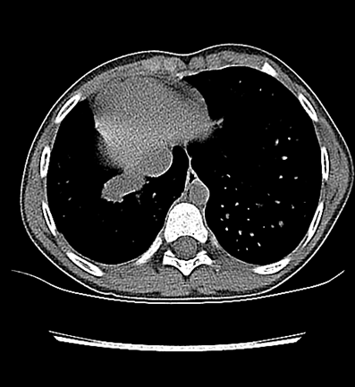 A 6-Year-Old Girl With Recurrent Shortness of Breath and Cough | Patient Case Quiz - Figure 2