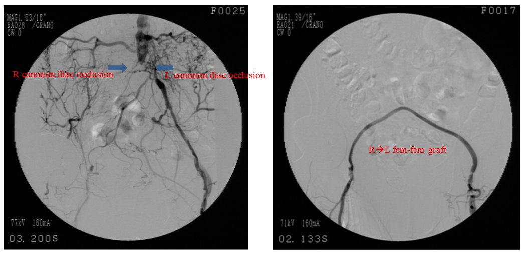 Endovascular Management of Complex Critical Limb Ischemia in a Non ...