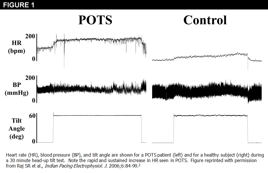 voorzetsel Klooster Mantel Postural Tachycardia Syndrome (POTS) Diagnosis and Treatment: Basics and  New Developments - American College of Cardiology