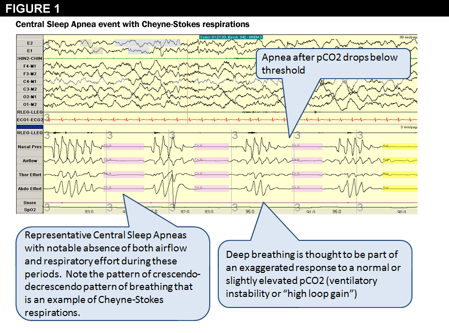 Figure 1: Central Sleep Apnea Event with Cheyne-Strokes Respirations