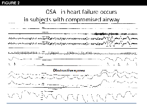 Figure 2: OSA in heart failure occurs in subjects with compromised airway