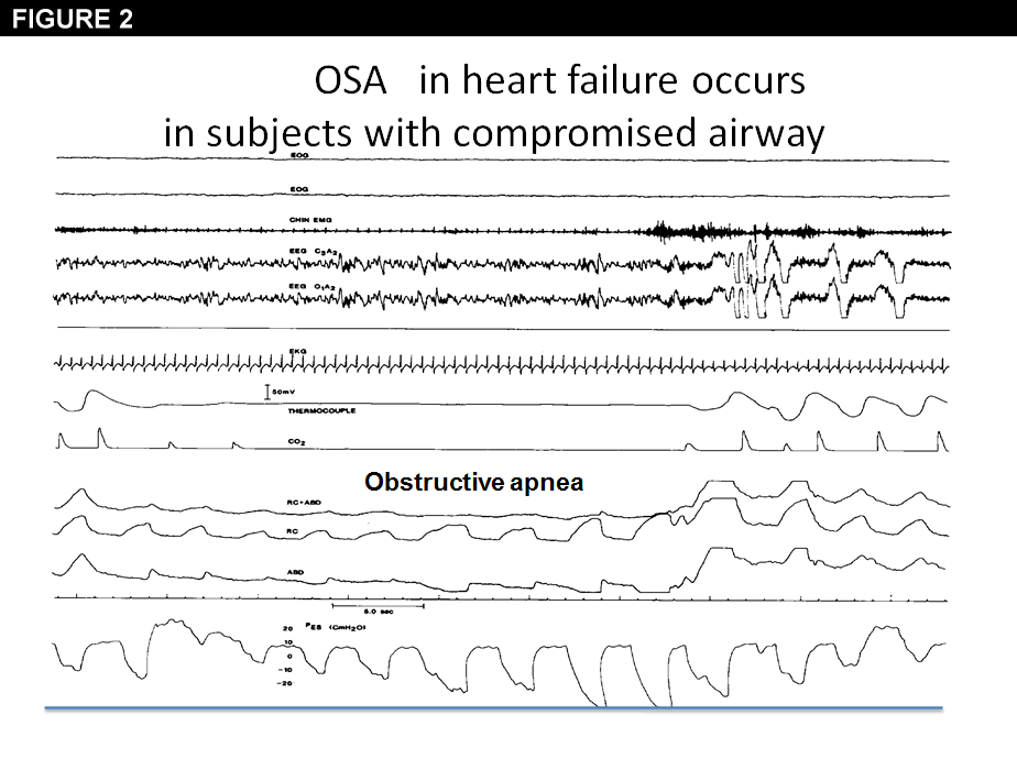 Figure 2: OSA in heart failure occurs in subjects with compromised airway