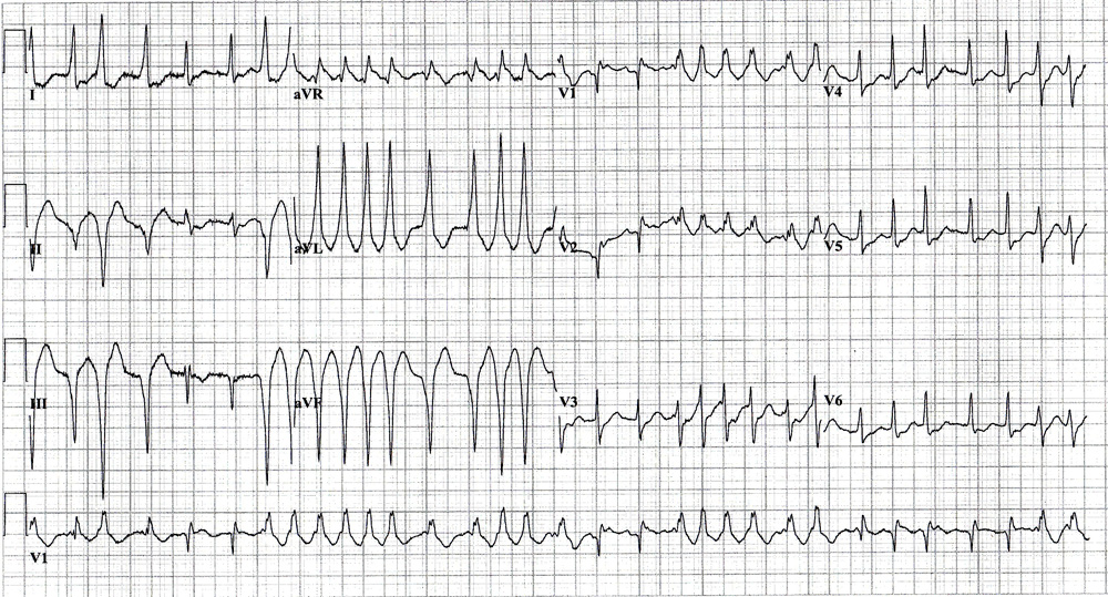 56-Year-Old Female With Palpitations, Lightheadedness, and Chest Discomfort