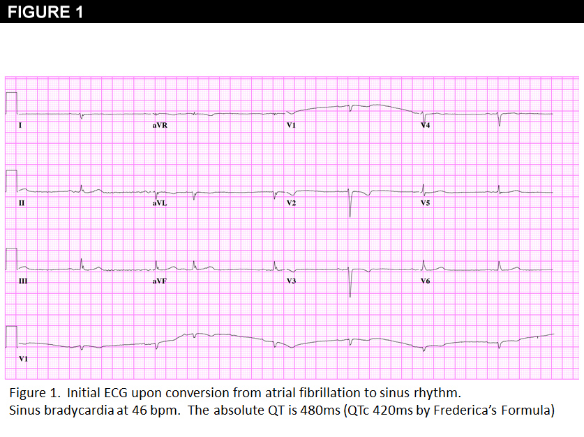 Figure 1: A 64-Year-Old Woman With Atrial Fibrillation and Syncope