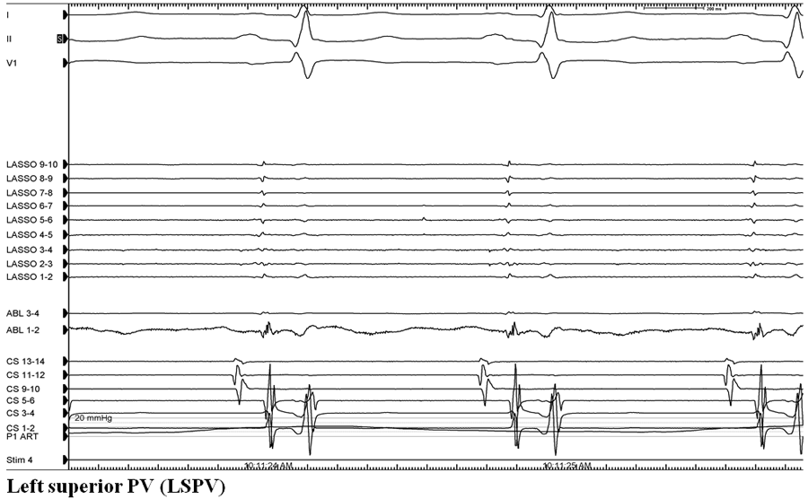 Figure 1:A 71-Year-Old Man With Recurrent AFib After Prior Ablation