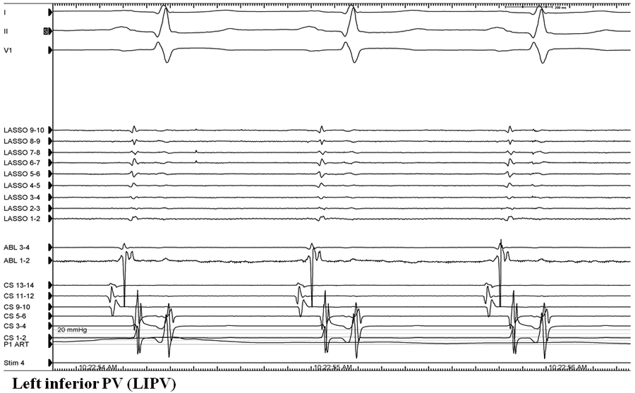 Figure 2: A 71-Year-Old Man With Recurrent AFib After Prior Ablation