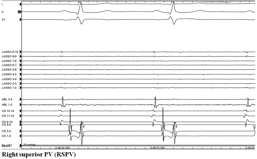 Figure 3:A 71-Year-Old Man With Recurrent AFib After Prior Ablation