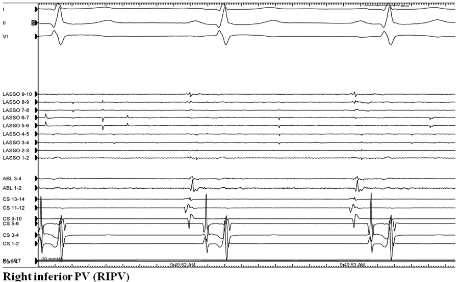 Figure 4:A 71-Year-Old Man With Recurrent AFib After Prior Ablation