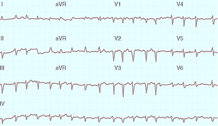 Figure 2: Anticoagulation in the Setting of AFib and Cardiac Amyloidosis