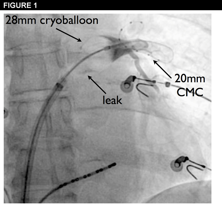 Figure 1: Assessing the Efficacy of Cryoballoon Ablation