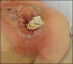 Pain and redness over pacemaker pocket.