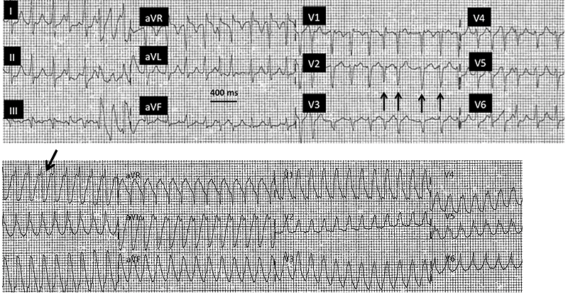Figure 1: ECG rhythm strips (top) 2 D-Echo - Structurally normal heart with preserved EF (bottom)