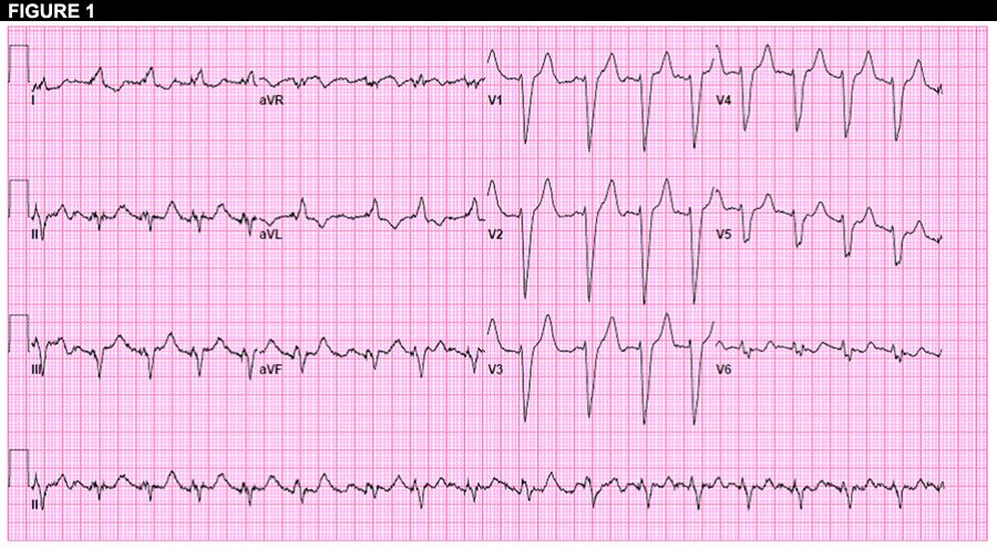 Figure 1: EKG in the ED