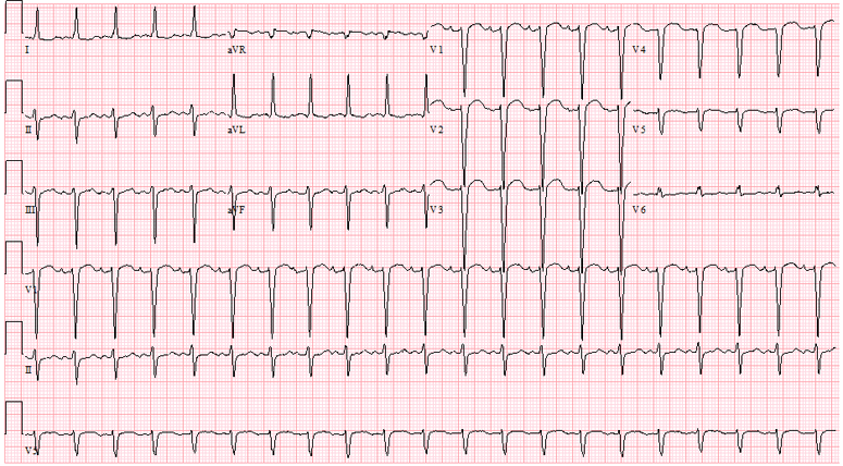 Figure 1:  Atrial tachycardia