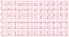 Figure 1: A 55-Year-Old Male on Statins Experiencing Sharp Chest Pain