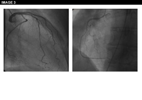 Figure 3: Angina Pectoris Despite Normal Coronary Angiography: Need for Specialist Care