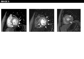 Figure 5: Angina Pectoris Despite Normal Coronary Angiography: Need for Specialist Care