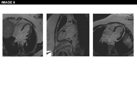 Figure 6: Angina Pectoris Despite Normal Coronary Angiography: Need for Specialist Care