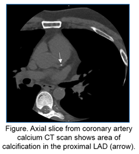 Figure 1: Axial slice from coronary artery calcium CT scan shows area of calcification in the proximal LAD (arrow)