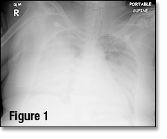 Figure 1: A 56-Year-Old Female With Acute Shortness of Breath