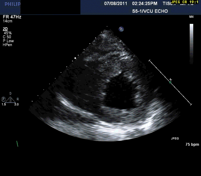 Figure 3: A 56-Year-Old Male With Shortness of Breath on Exertion