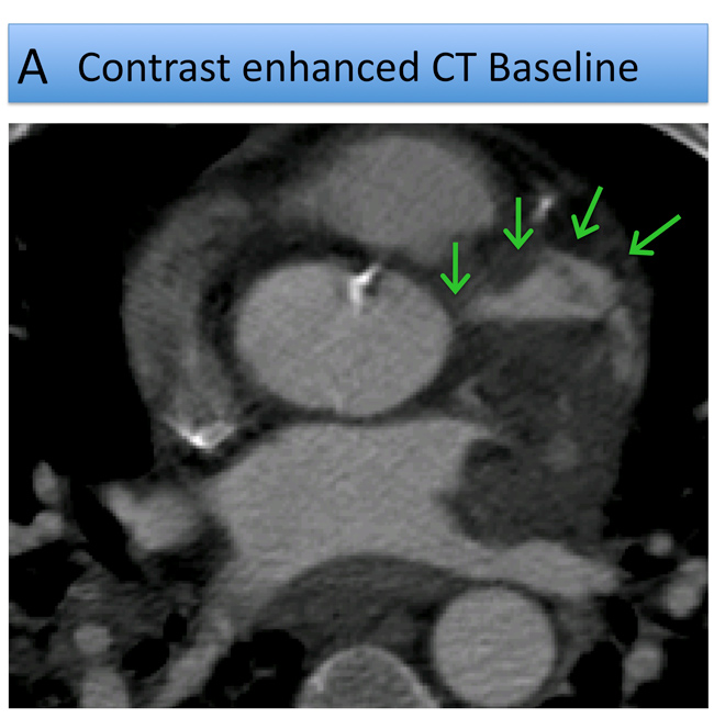 Figure 1: A 58-Year-Old Man Presents With Anterior NSTEMI