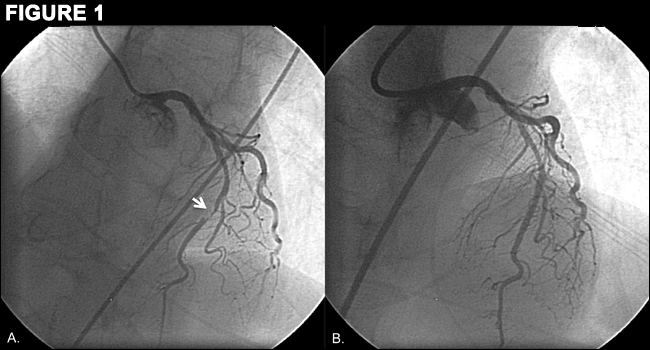 Figure 1: Acute Stent Thrombosis: Technical Complication or Inadequate Antithrombotic Therapy? An Optical Coherence Tomography Study