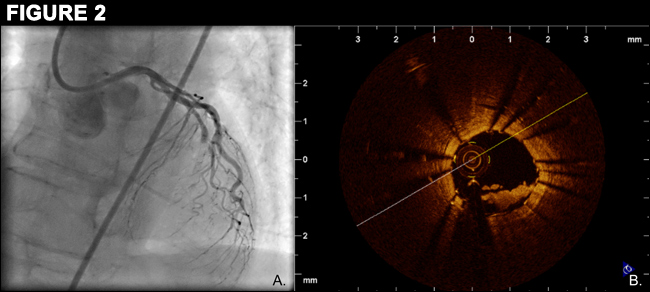 Figure 2: Acute Stent Thrombosis: Technical Complication or Inadequate Antithrombotic Therapy? An Optical Coherence Tomography Study