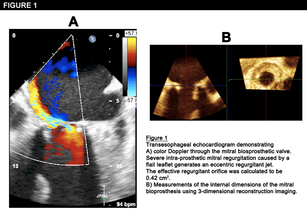 Figure 1: Concomitant Transcatheter Aortic and Mitral Valve-in-Valve Replacements Using Transfemoral Devices Via the Transapical Approach: First Case in the U.S.